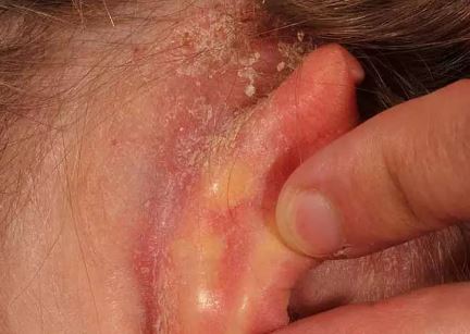 راهکارهای خانگی برای درمان خارش پشت گوش خارش