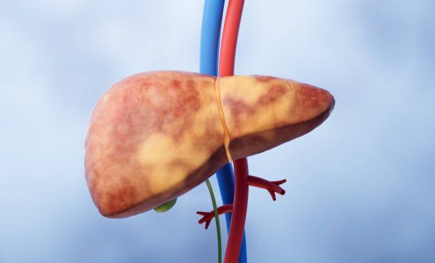 مهم ترین علت پیوند کبد در ایران/ زنگ خطر کبد چرب Fatty Liver