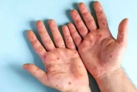 هشدار برای شیوع ویروس آبله میمونی در اروپا هشدار برای شیوع ویروس آبله میمونی در اروپا